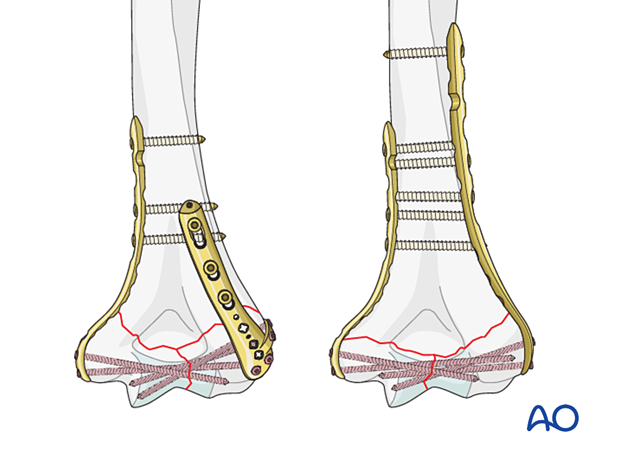 ORIF - Plate fixation