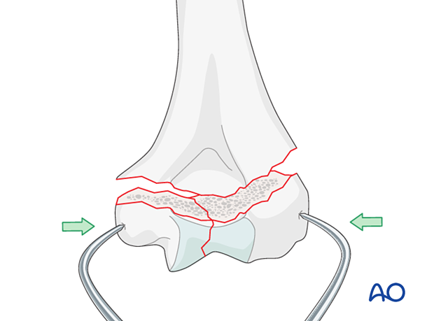 Holding the reduction of the articular block with forceps, gaining extrinsic interfragmentary compression