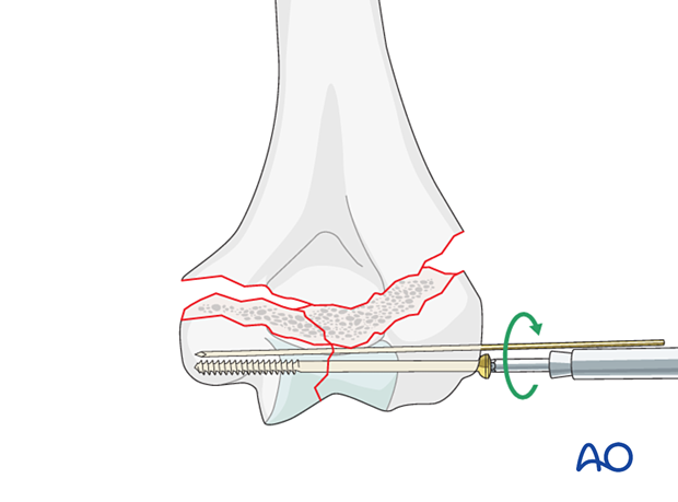 Lag screw fixation of the intraarticular fracture