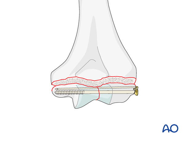 Lag screw fixation of the intraarticular fracture with additional K-wire 