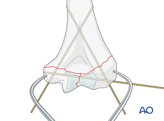 Temporary K-wire fixation of metaphyseal fracture reduction