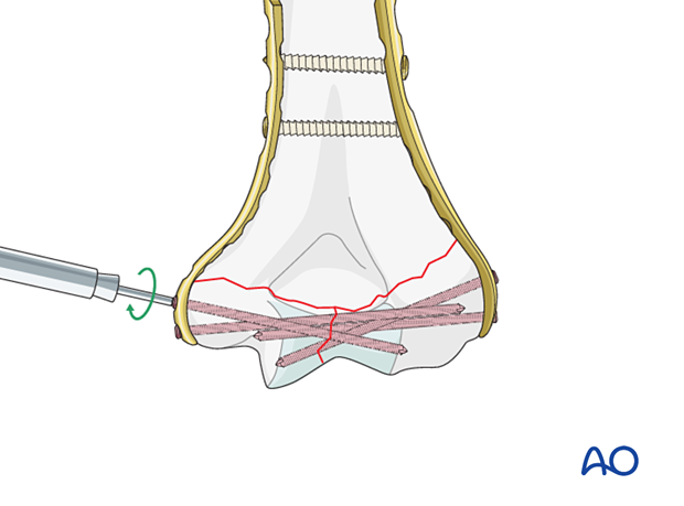 Insertion of locking screws into the articular block