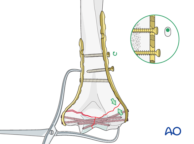 Lateral supracondylar compression with eccentrical loading screw