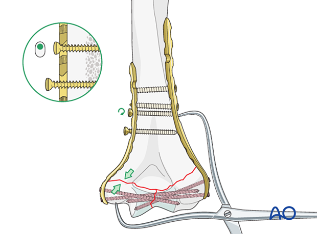 Medial supracondylar compression with eccentrical loading screw