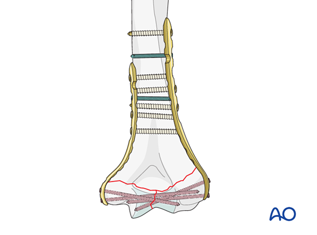 Plate fixation in poor-quality bone with additional locking screws