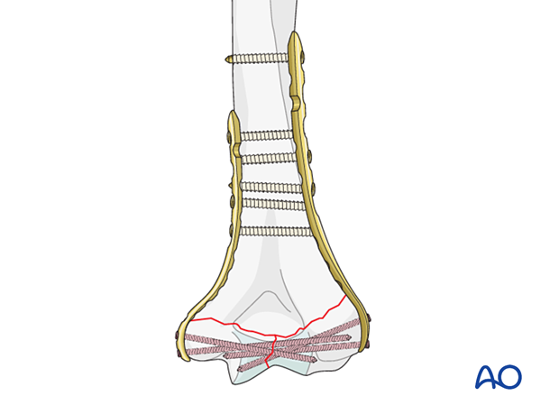 ORIF - Plate fixation