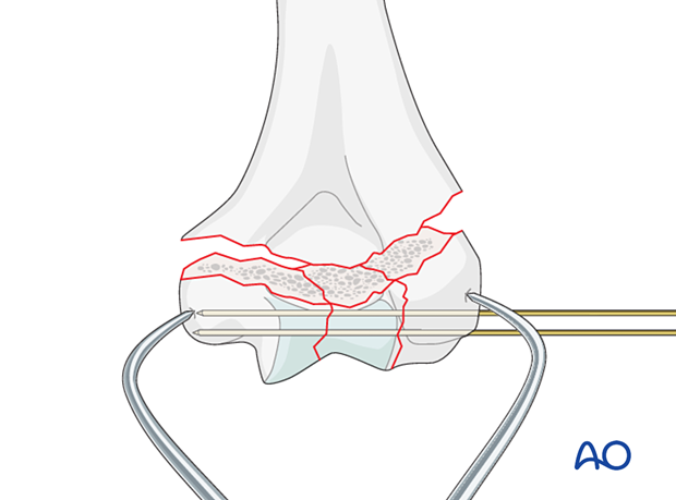 Temporary K-wire stabilization of the intraarticular fracture