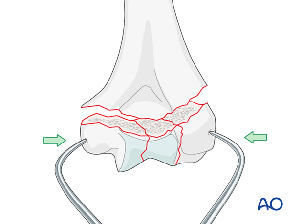 Holding the reduction of the articular block with forceps, gaining extrinsic interfragmentary compression