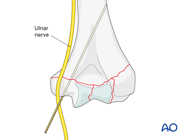 Ulnar nerve at risk if the fracture exits just above the medial condyle.