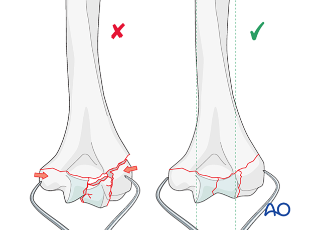 Overcompression of the articular fragments