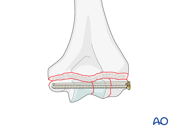 Position screw fixation of the intraarticular fracture with additional K-wire