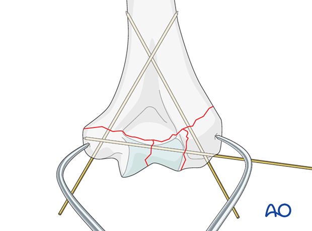 Temporary K-wire fixation of metaphyseal fracture reduction