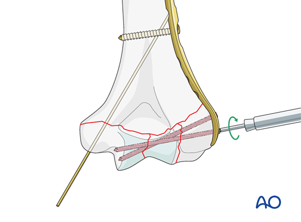 Insertion of locking screws into the articular block