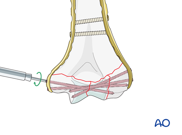 Insertion of locking screws into the articular block