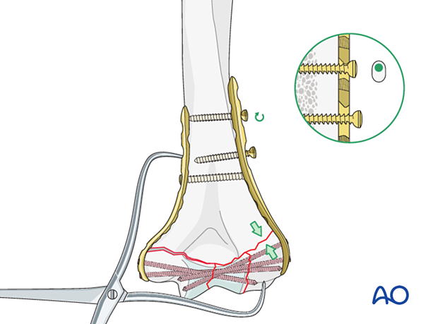 Lateral supracondylar compression with eccentrical loading screw