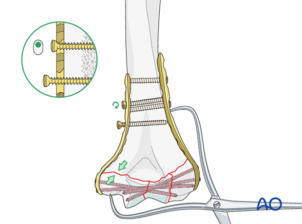 Medial supracondylar compression with eccentrical loading screw