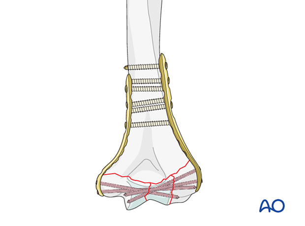 Plate fixation in poor-quality bone with additional locking screws