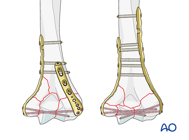 ORIF - Plate fixation