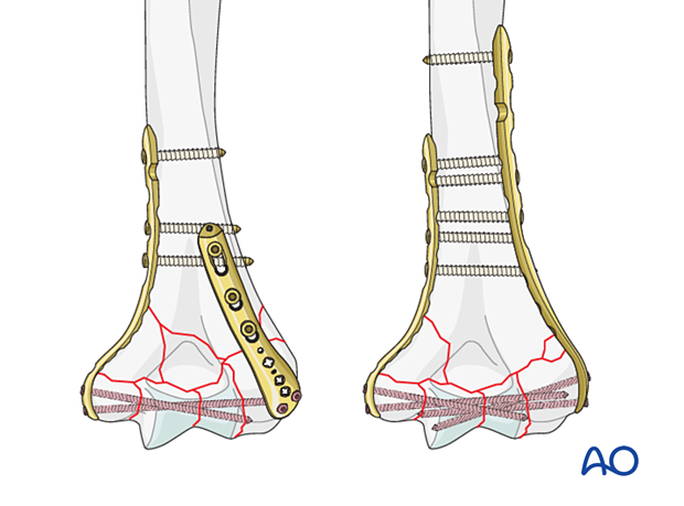 If both columns have comminuted fractures, then both are stabilized by bridge plating