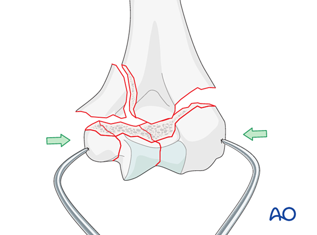 Holding the reduction of the articular block with forceps, gaining extrinsic interfragmentary compression