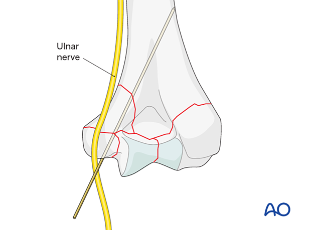 Ulnar nerve at risk if the fracture exits just above the medial condyle.