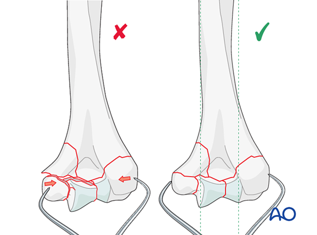 Overcompression of the articular fragments