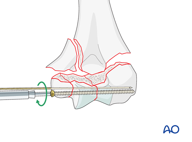 Position screw fixation of the intraarticular fracture