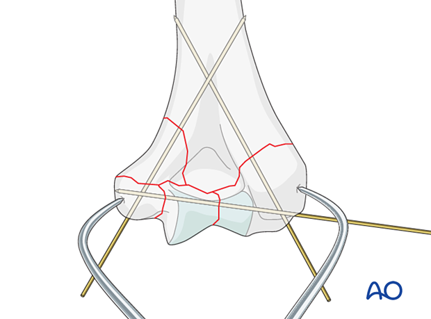 Temporary K-wire fixation of metaphyseal fracture reduction