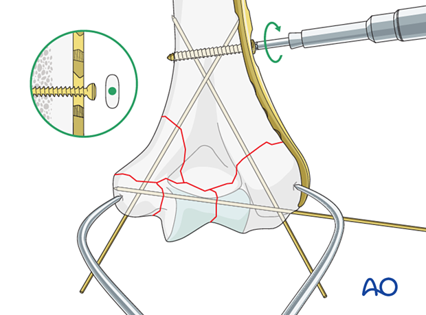 Provisional fixation of the lateral plate to the bone with a cortical position screw through a slotted combihole proximal to the fracture