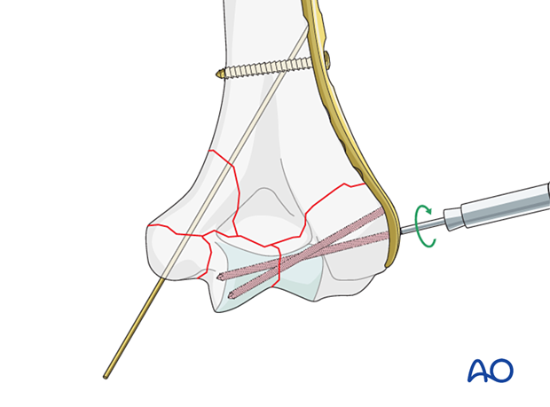 Insertion of locking screws into the articular block