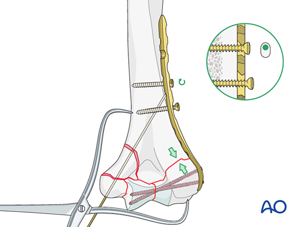 Compression is applied to the simple column fracture before placement of the other plate.