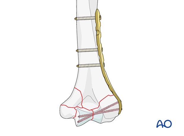 Compression plating of the simple column fracture before placement of the other plate