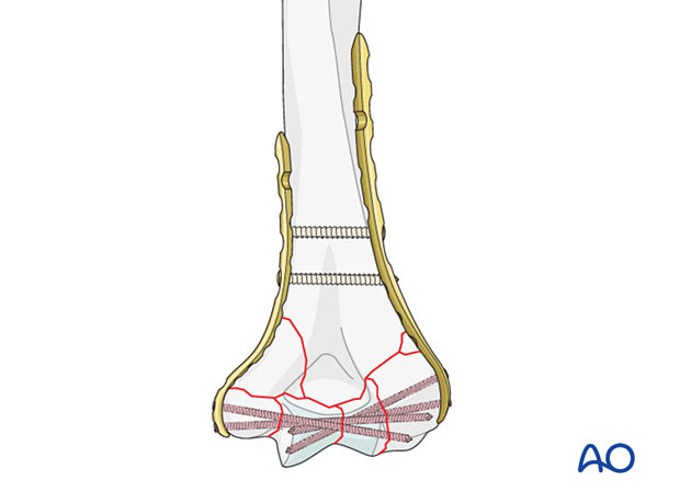 Provisional application of the second plate to the bone