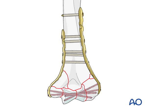 Parallel bridge plating