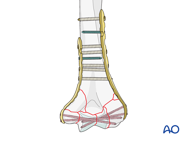 Parallel bridge plating with additional locking screws in poor-quality bone