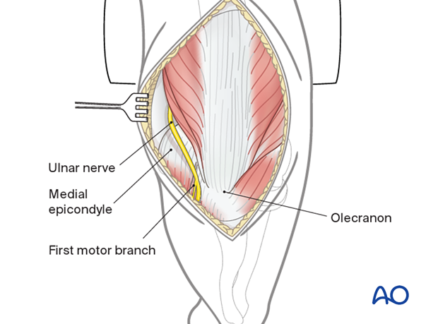 Ulnar nerve management