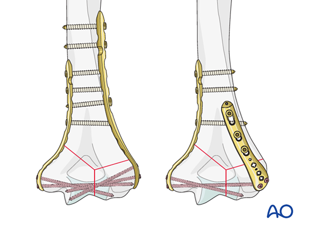 Parallel and perpendicular plating of distal humeral fracture