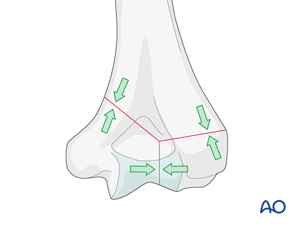 Fracture compression in the distal humerus