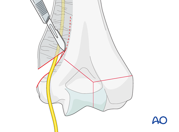 Releasing the intermuscular septum from the medial ridge of the distal humerus to allow for plate application