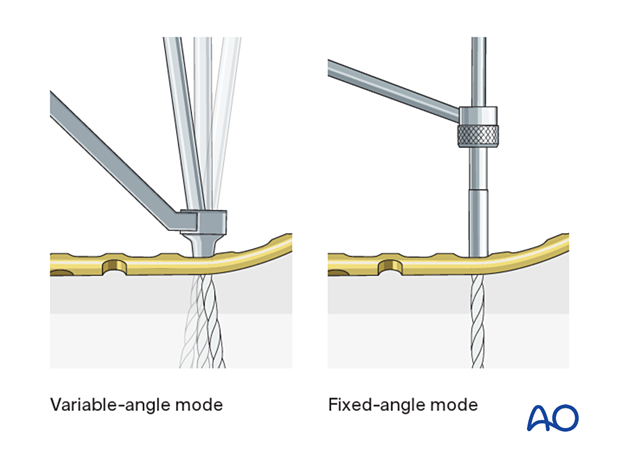 Screw insertion in distal plate in variable-angle and fixed-angle mode