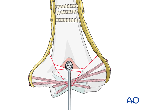 If the olecranon fossa is reduced in size by this procedure, it is important to burr out a new fossa to accommodate the olecranon and allow full extension.