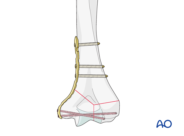 Medial plating of distal humeral fracture