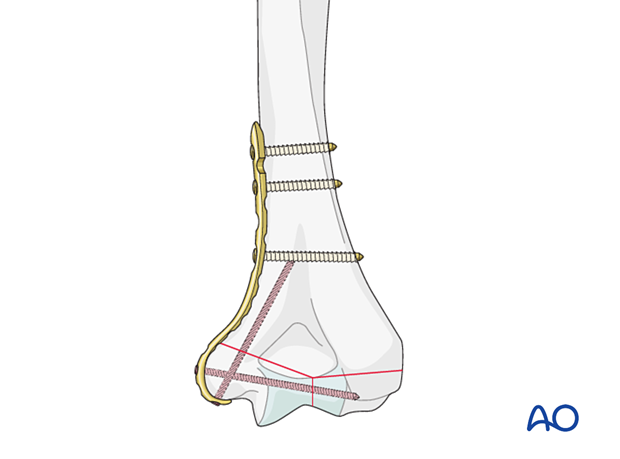 Application of a medial plate with extension around the medial epicondyle and ascending column screw