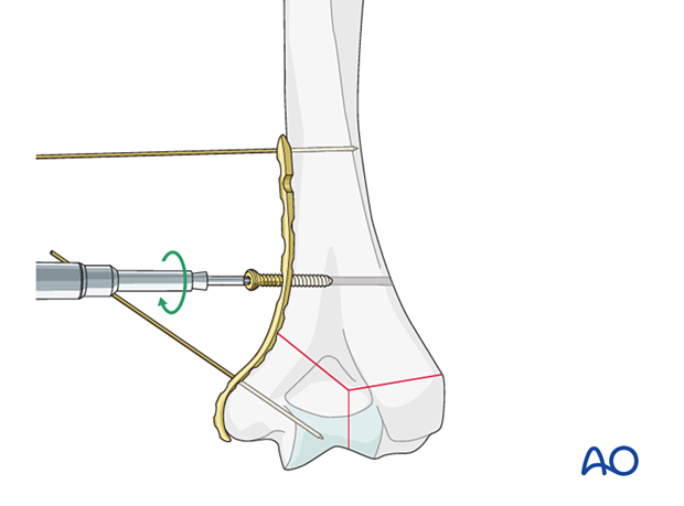 Provisional fixation of the plate to the bone with a cortical position screw through one of the combiholes proximal to the fracture zone