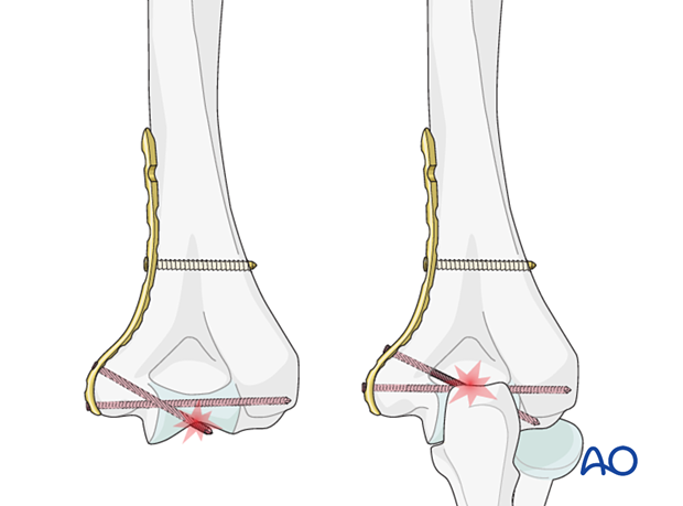 Articular penetration of screws and screws through the olecranon fossa