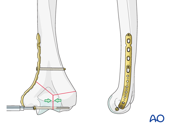 Intrinsic compression applied by insertion of a transverse lag screw separate to the plate