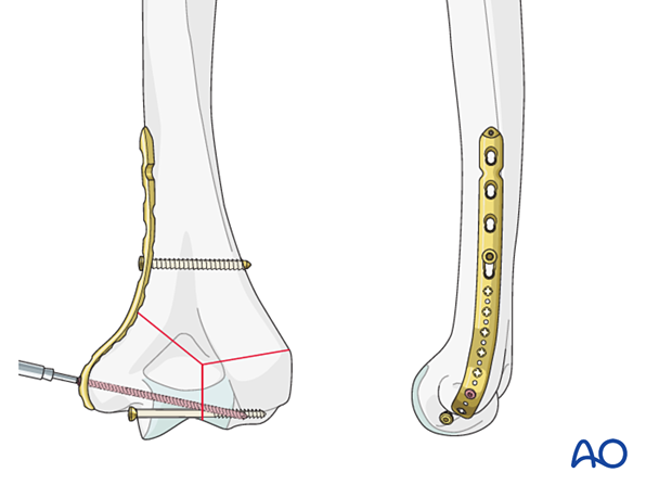 Adding a locking screw through the articular block