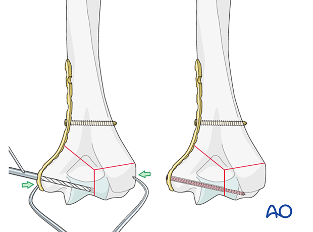 Extrinsic compression applied by a forceps and maintained with a locking screw through the plate