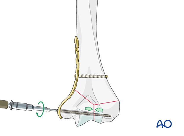 Intrinsic compression applied by insertion of a metaphyseal lag screw through the plate