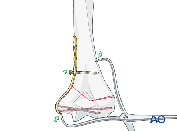 Supracondylar compression with forceps